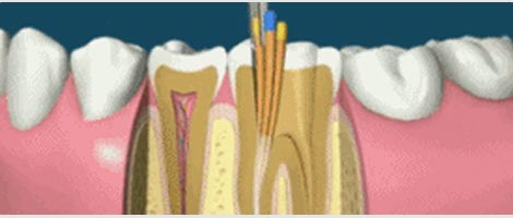中重度牙周病方案微創根管治療術